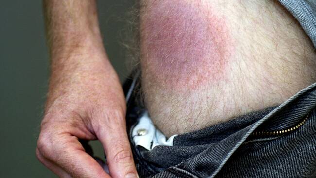 borrelia efter behandling borrelia efter behandling