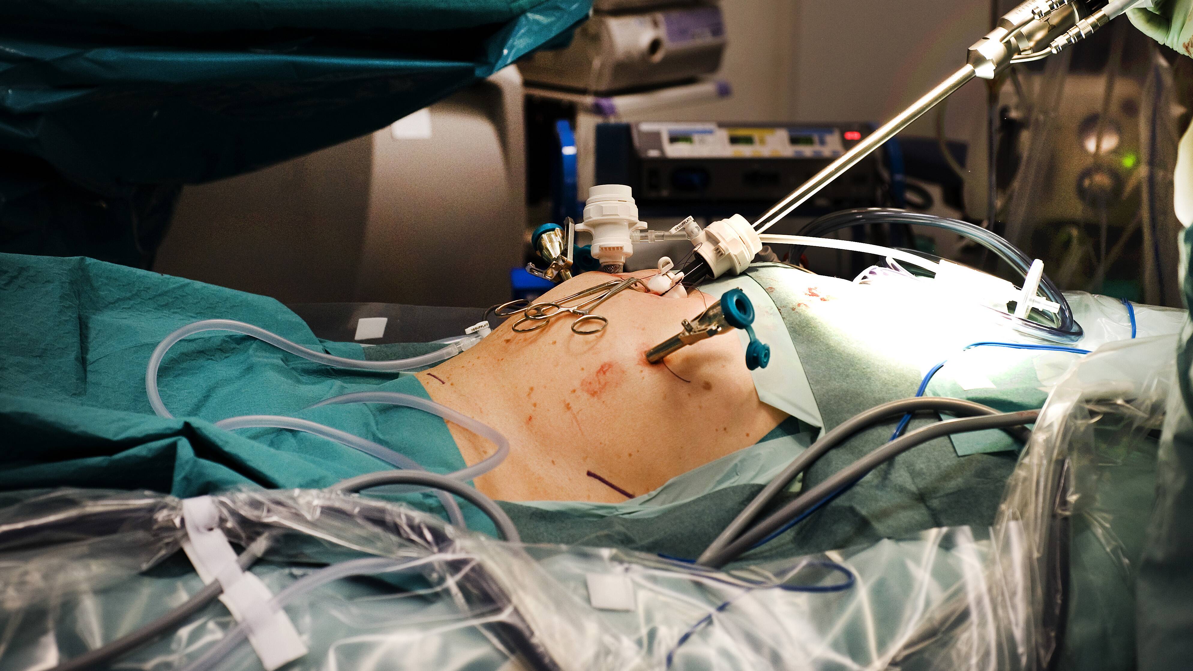 prostatacancer operation biverkningar prostatacancer operation biverkningar