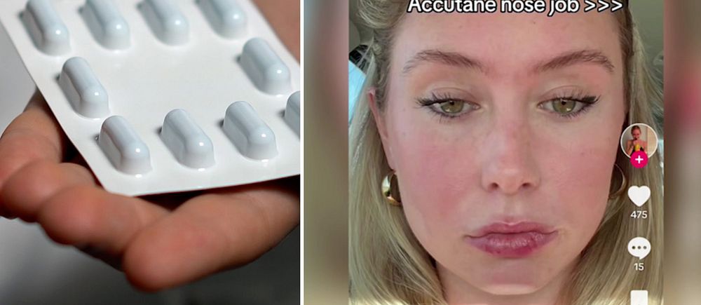 På sociala medieplattformen Tiktok påstår användare att deras näsa krympt efter att de tagit den starka aknemedicinen Isotretinoin, även kallat Roccutane eller Accutane.