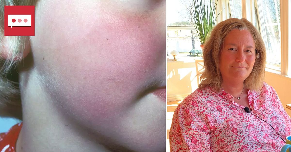 3 frågor om femte sjukan: Har ökat på flera håll – det behöver du veta ...