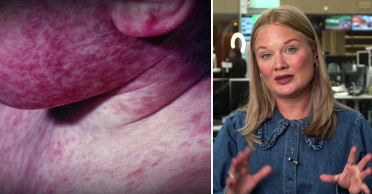 S&aring; smittar m&auml;ssling &ndash; och s&aring; farligt &auml;r det