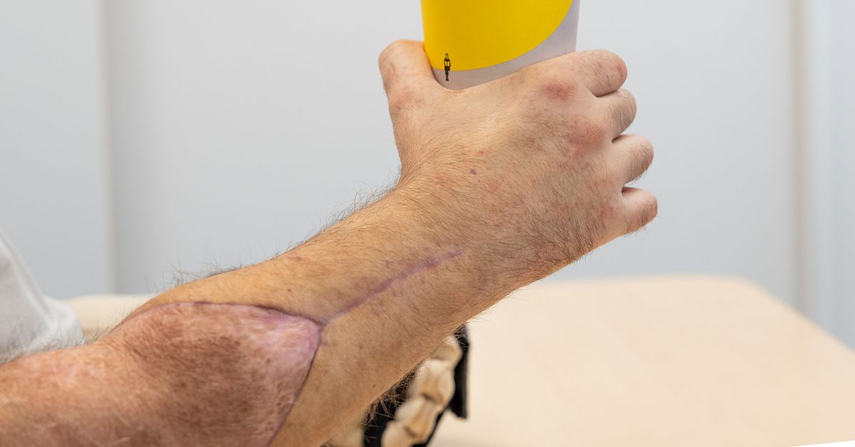 Så gick det till när patient fick nya händer på Södersjukhuset