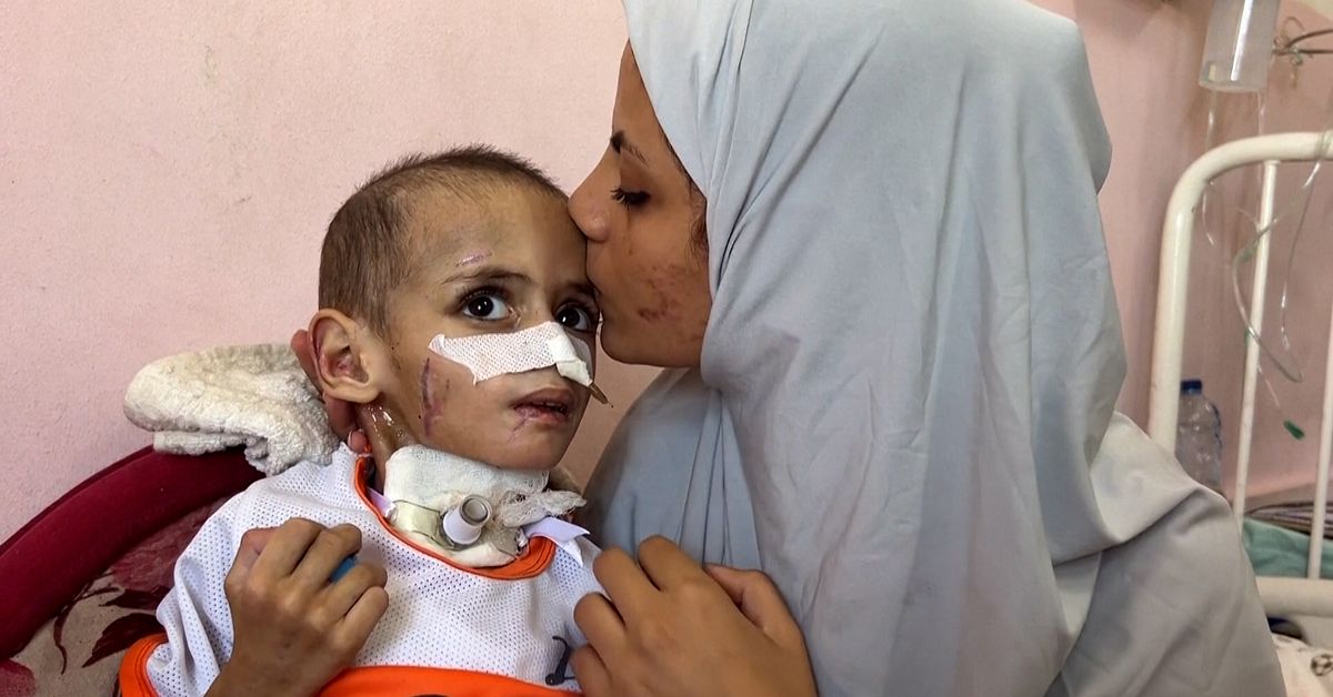 Treårige Amr fick hjärnskada efter israeliskt anfall – saknar vård i Gaza
