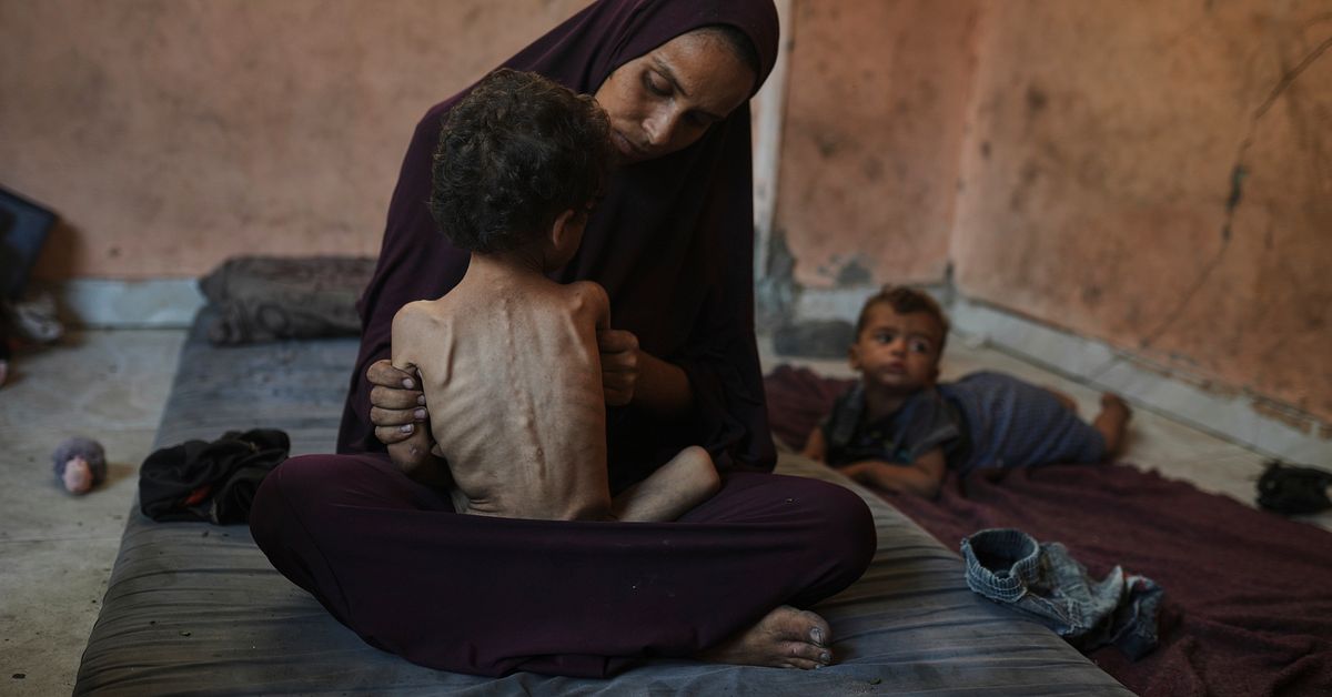Svälten breder ut sig – Yazan har tappat halva sin vikt