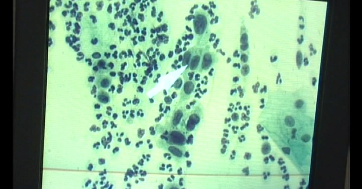 Hpv-vaccin: Så många regioner nådde målet