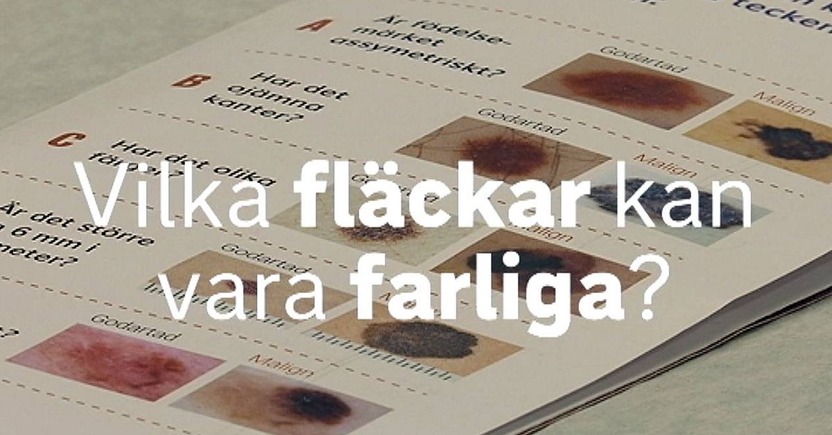 Så håller du koll på dina leverfläckar SVT Nyheter