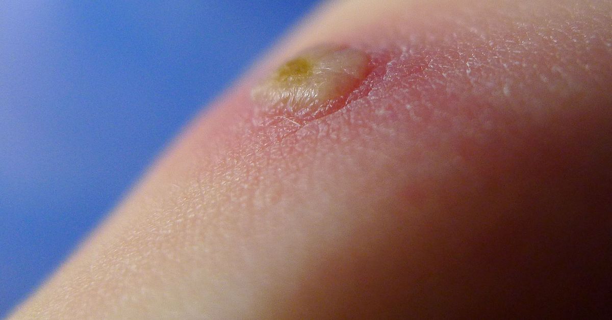 Anm&auml;lningsplikt f&ouml;r vattkoppor och RS-virus