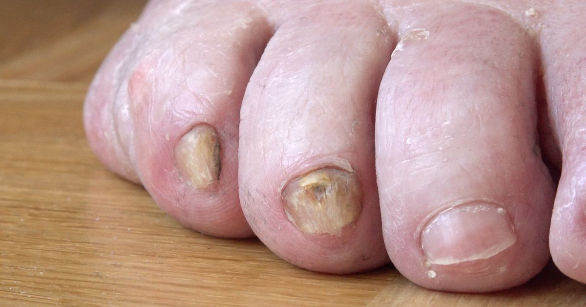 Han har k&auml;mpat med skamfyllda sjukdomen i 20 &aring;r