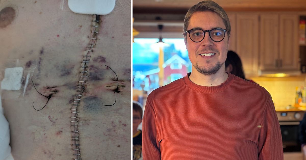 Eric Wallberg från Arvika blev första vuxna svensk med unik organtransplantation – fick nytt hjärta och ny lever
