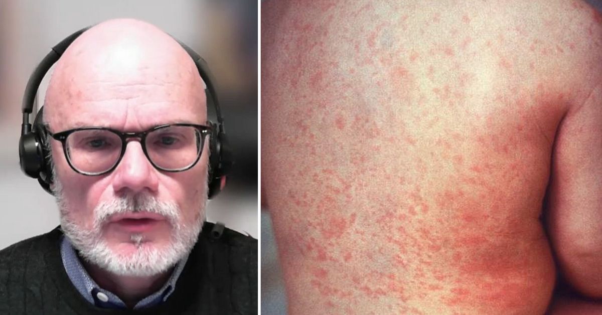 Larmet: Nya fall av röda hund i Göteborgsområdet | SVT Nyheter