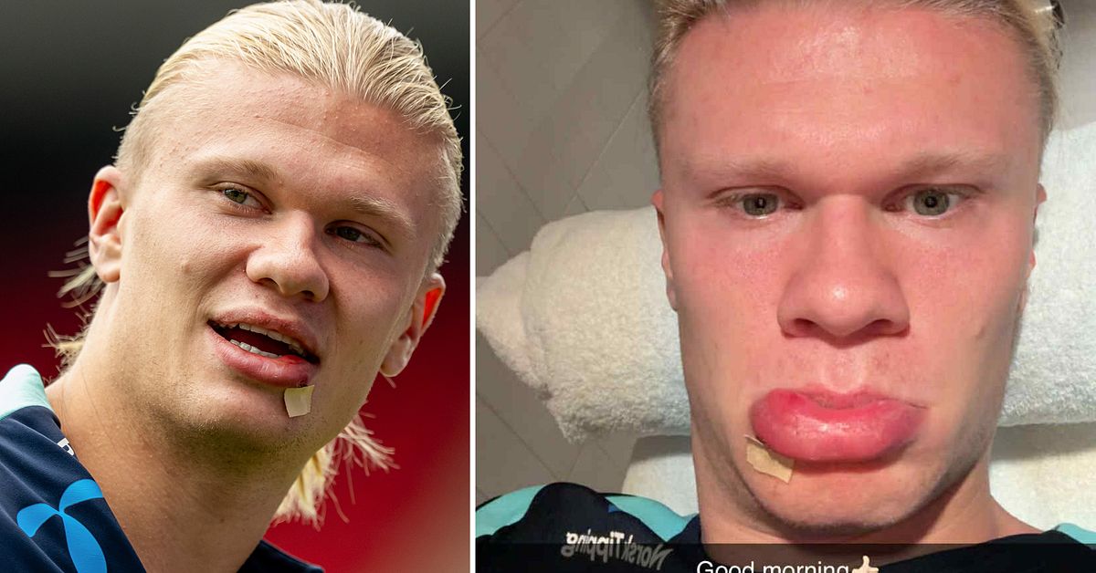Erling Haalands dråpliga olycka – fick sy tre stygn