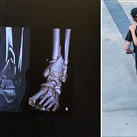 Två bilder. Röntgenbild på fotled som skadats i samband med en olycka på elsparkcykel. Samt pojkar som åker på en elsparkcykel – bilden är tagen bakifrån.