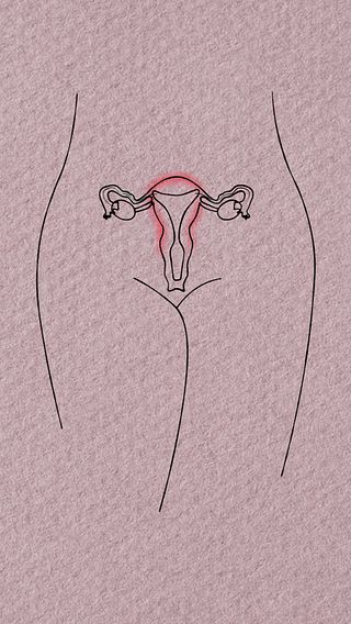 Det här är endometrios