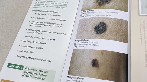 melanotan uppladdningsfas Kp 2 i Sverige - Forskningspeptid Malignt melanom - orsak, symtom