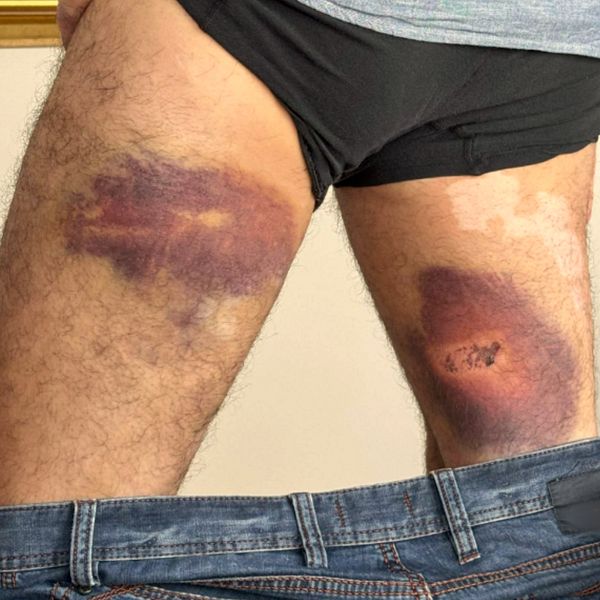 Fredrik Viktorins blåmärken efter polisingripande samt bild från Åmåls bluesfestival 2024.