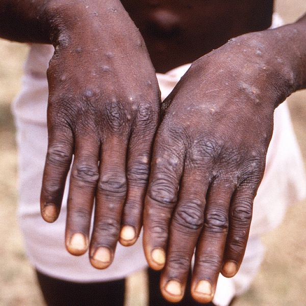 Händer på person smittad av mpox