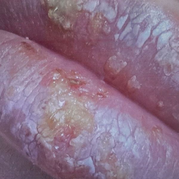 Delad bild. Såriga läppar till vänster. En bild på en som gör fillers.