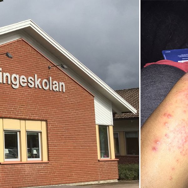 Getingeskolan och arm med kraftigt eksem