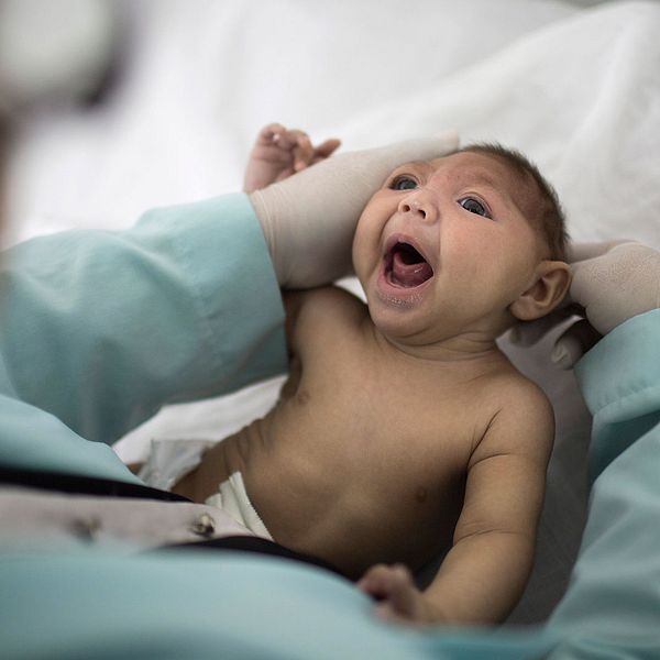 Ett spädbarn med mikrocefali.
