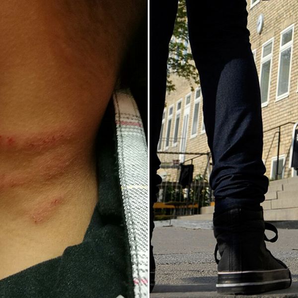En pojke i förskoleklass på Augustenborg som blivit riven på halsen.