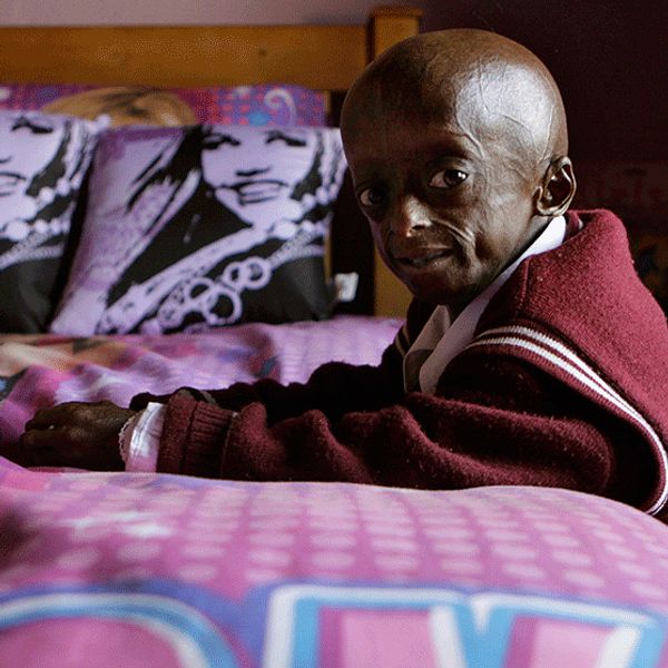 Sydafrikanska Ontlametse Phalatse är ett av barnen som lider av sjukdomen progeria.