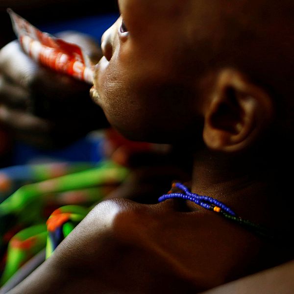 Ett spädbarn vårdas för undernäring på sjukhus i Juba.