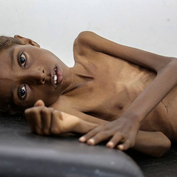 Fem-åriga Mohannad Ali lider av svält ligger. Han på ett sjukhus i Abs, Jemen. Arkivbild.