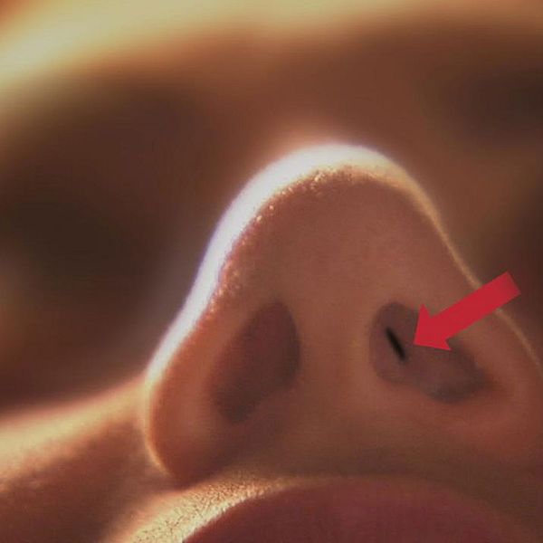 Vissa patienter har fått andningshål i näsan så små som riskorn.
