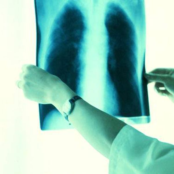Röntgenbilder på lungor