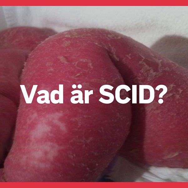 Frågan ”Vad är SCID”. Bebisben fyllda med blåsor och sår.