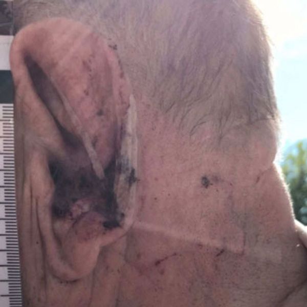 En äldre mans öra som är blodigt och delvis tejpat. Mot mannens huvud ligger en linjal från polisens undersökning.