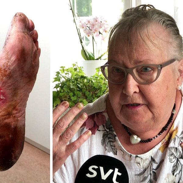 Gunnel Wojahn drabbades av stora skador när hon rensade ogräs och fick växtsaft från en björnloka på sig.