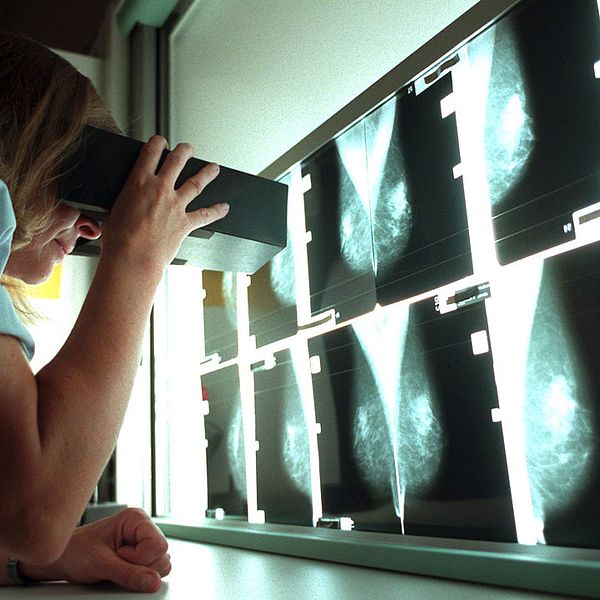 Läkare granskar röntgenbilder från mammografi