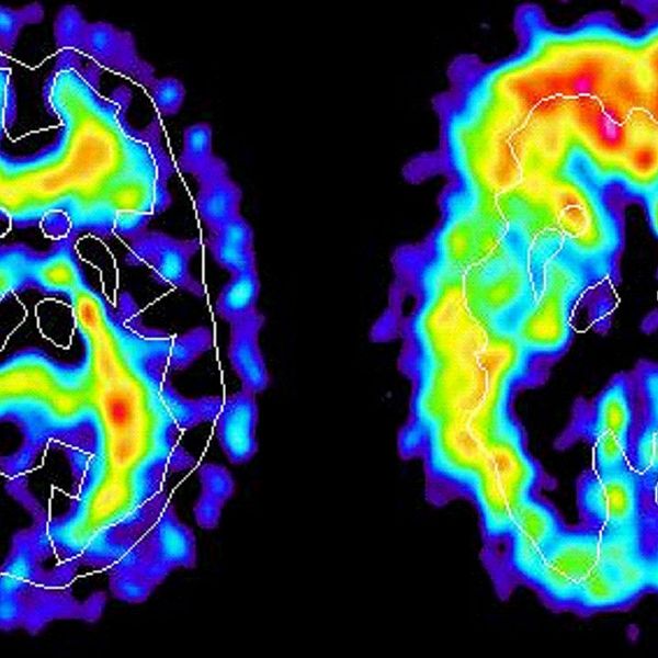 Hjärnan har förändrats långt innan Alzheimers sjukdom bryter ut hos en människa. Nästan 20 år tidigare drabbas hjärnan av inflammatoriska förändringar som tycks vara kopplade till sjukdomen.