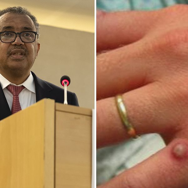 Bildföreställande WHO:s generaldirektör Tedros Adhanom Ghebreyesus och en hand tillhörande en person som insjuknat i apkoppor.