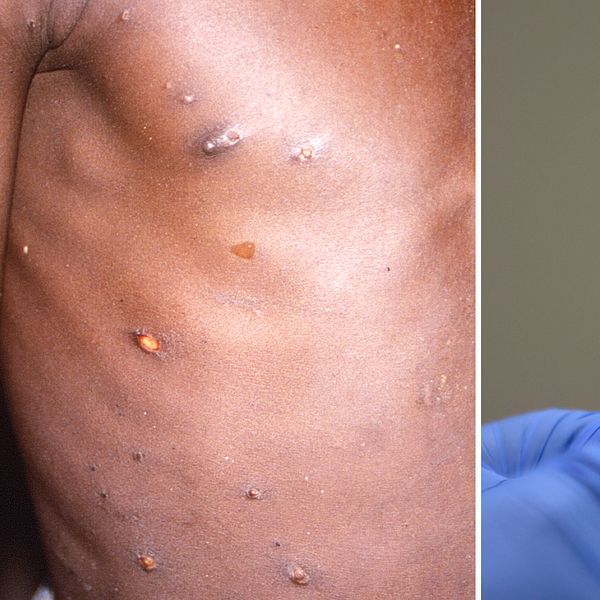 Till vänster en kropp med apkoppor, till höger en burk med vaccin och en spruta.