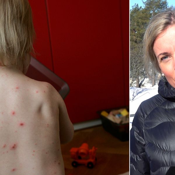 Kollage: Till vänster ett barn med vattkoppor som sitter med ryggen mot kameran. Till höger Västerbottens biträdande smittskyddsläkare Therese Thunberg. Hon har ljust uppsatt hår och svart vinterjacka.