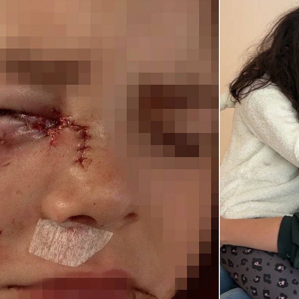 Till vänster: Närbild på Umeåbon Sara Bergmarks dotters ansikte, som är svullet och har flera sydda sår efter att ha attackerats av en hund. Till höger: Sara Bergmarks sitter och håller om sin dotter.