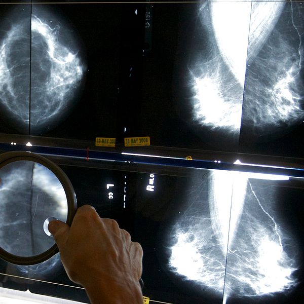 Läkare som tittar på röntgenbilder från en mammografi.
