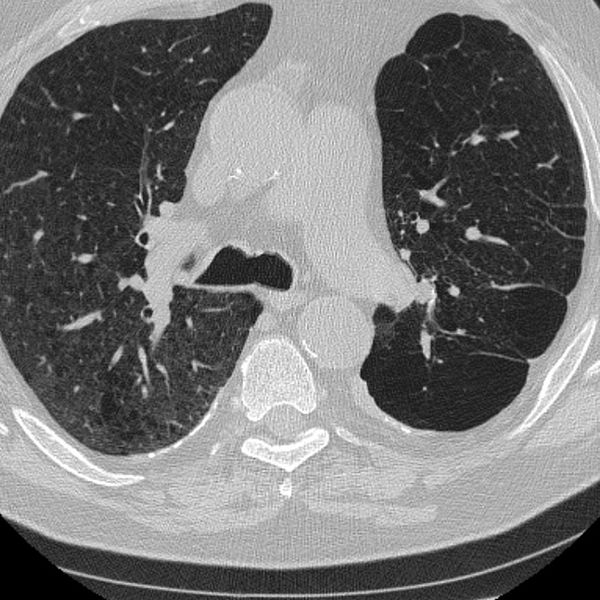 Lungor med KOL jämfört med friska lungor (mindre bilden).