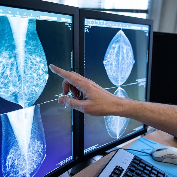 Läkare granskar mammografiresultat på två datorskärmar.