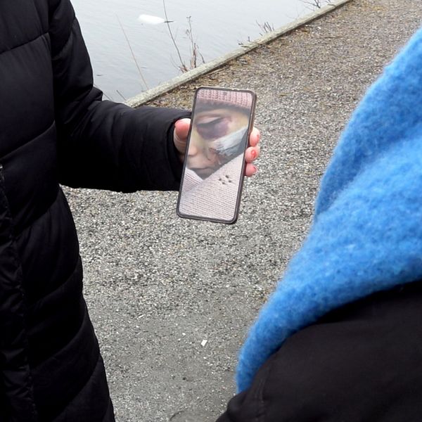En tvååring fick efter en olycka på Bergviks förskola i Södertälje åka in till akuten med allvarliga skador. På en mobil visas skadorna upp.