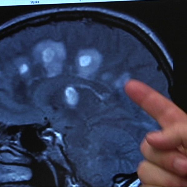 En person pekar på en MR-bild av en hjärna som visas på en datorskärm. Bilden visar olika ljusa områden som representerar anatomiska strukturer eller potentiella avvikelser i hjärnan.