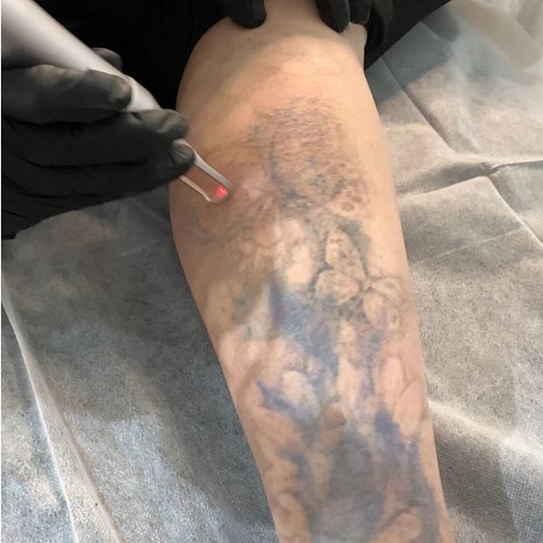 Marleen Silvernacke tar bort tatuering med hjälp av en laser