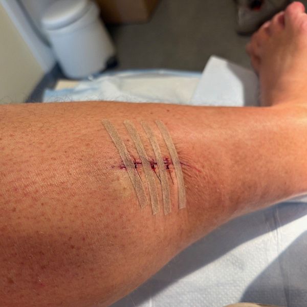 Tvådelad bild. Vänster: man i mörk skjorta. Höger: skadad ben med sår och plåster, skador efter en vildsvinsattack