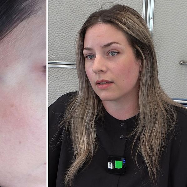 Sussi Martens fick ett blåmärke efter botox