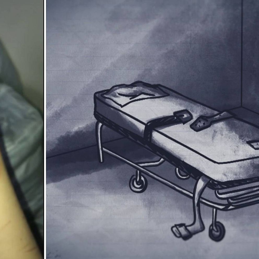 Arm med blåmärken efter bältning, bältessäng.