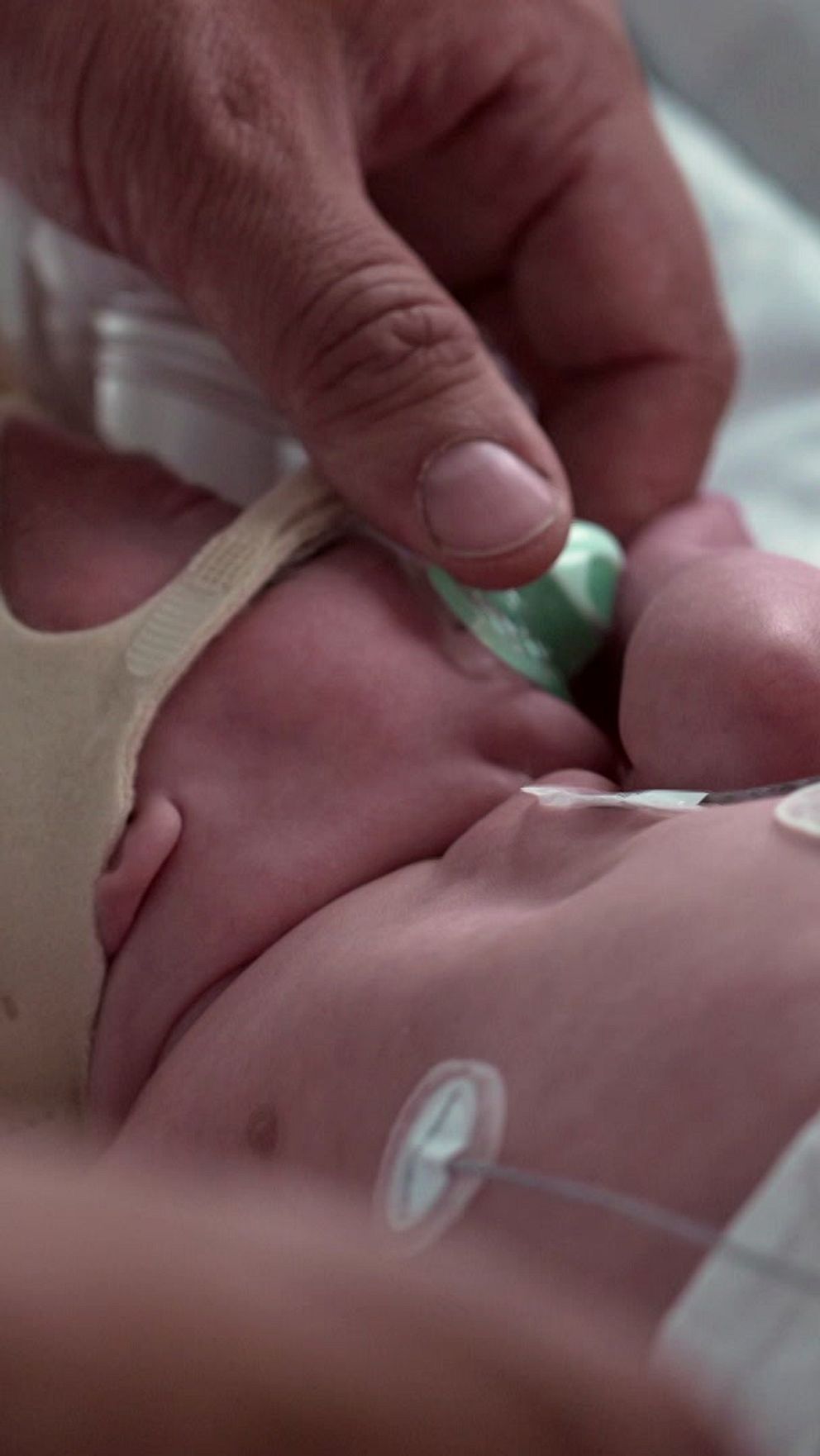 Nyfödd med vårdslangar hålls av vårdpersonal under neonatalvård