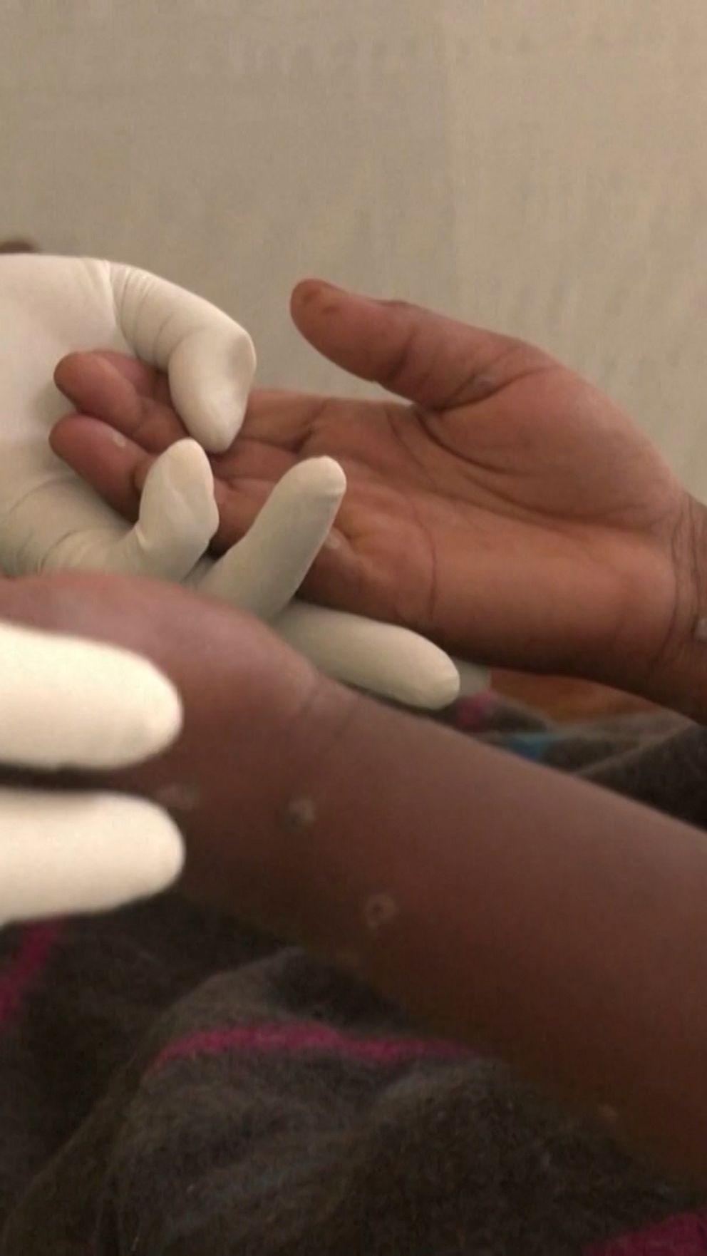 Sjuksköterska med vita handskar och person smittad av mpox