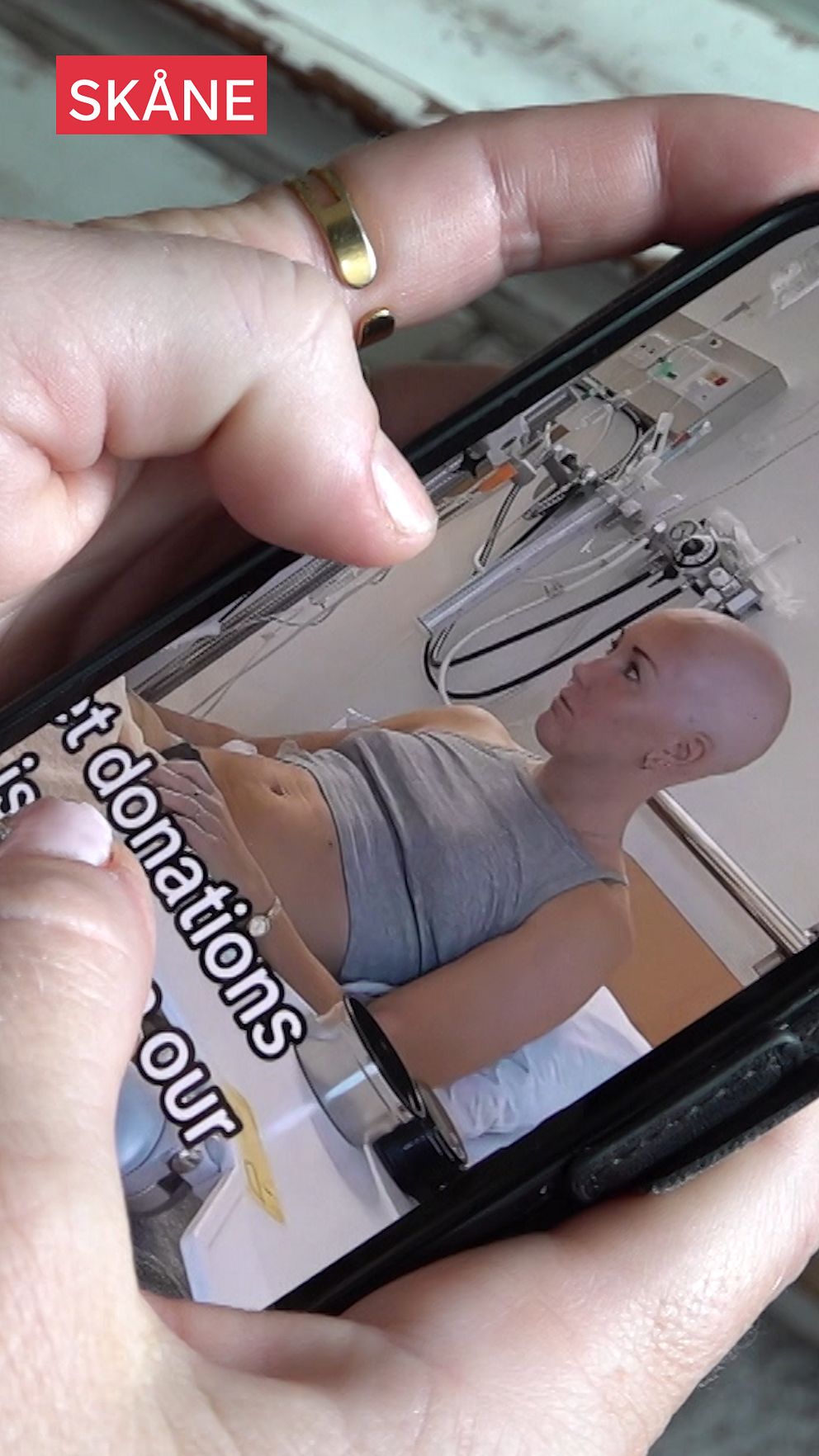 En person med kalt huvud ligger i sjukhusbädd, visas på mobilskärm. Text ”Skåne” i hörnet.